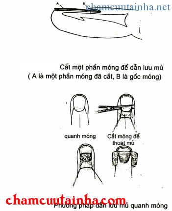 Viêm mủ dưới móng